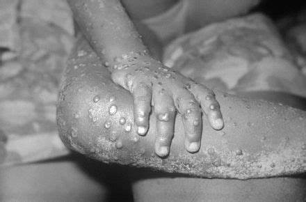 Photo de Un cas confirmé de la variole du singe au Maroc