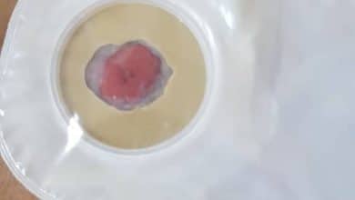 Opérations chirurgicales en cathétérisme et en urologie à Nouakchott 1 Photo de Opérations chirurgicales en cathétérisme et en urologie à Nouakchott