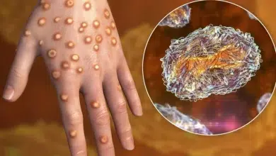 Mauritanie: Les autorités renforcent leur engagement face a l’épidémie de variole 13 Photo de Mauritanie: Les autorités renforcent leur engagement face a l’épidémie de variole