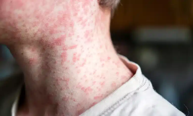 Photo de Recrudescence de la rougeole en France, liée à une épidémie majeure au Maroc