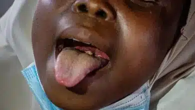 Photo de Rapid response halts diphtheria outbreak among refugees in Mauritania